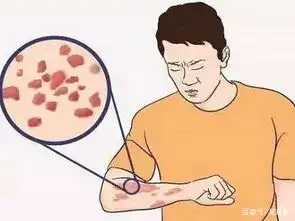  神经性皮炎那都不是事