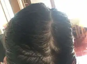  肝不好,先看发若头发没有这三种表象,恭喜,肝脏还算健康身体