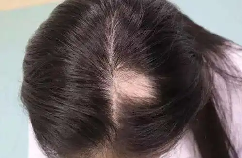  剃头改善宝宝发质,没有科学依据头发是否浓密与4点有关