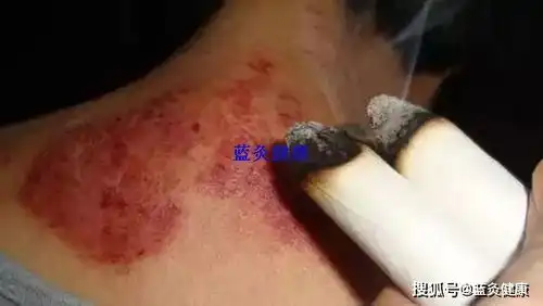  艾灸能治皮肤疾病吗常见的皮肤病都有哪些症状