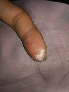  手指划伤了,消毒后变白色,请问怎么回事啊