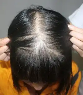  弥漫性脱发能治好吗女人弥漫性脱发怎么治疗