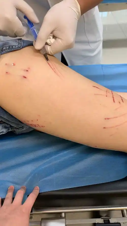  重庆女子外出遭一家养猫严重抓伤,需打二十多针免疫球蛋白,哪些因素会导致猫发狂此类事故该如何定责