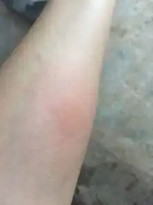  好像是被毒蚊子咬了,已经三天了,越来越肿,这是正常的么