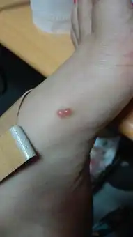  蚊子咬后,变成了水泡,好大一个,怎么办,是什么情况