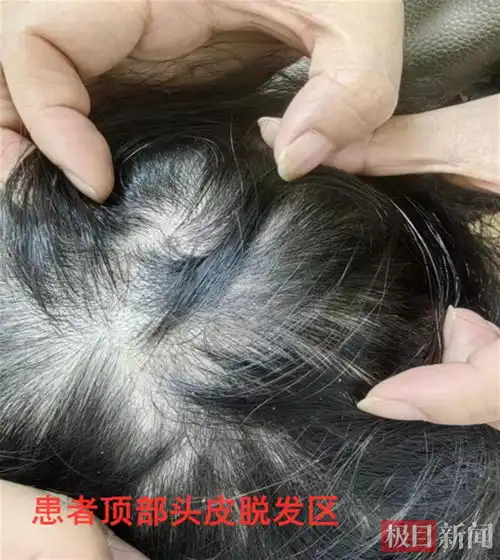  一个月逛8次猫咖,14岁少女染上宠物癣头顶脱发