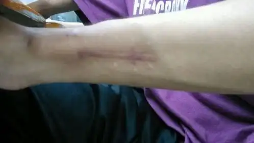  每年征兵体检时,为何身上有伤疤的人不能参军主要有三个原因