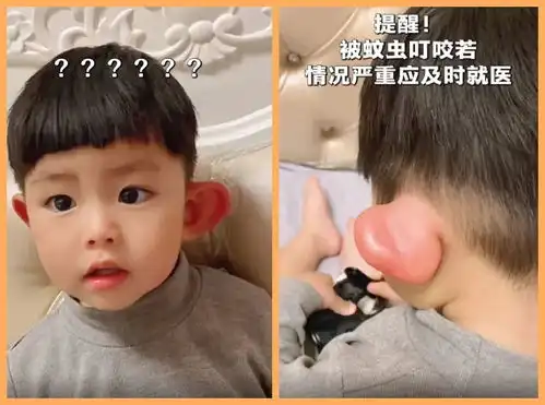  宝宝外出被蚊虫叮咬,耳朵肿成大耳朵图图,亲妈一旁笑不停