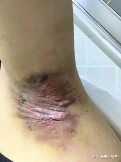  千万别做腋臭手术