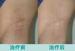  消除腋臭的价格一般要多少