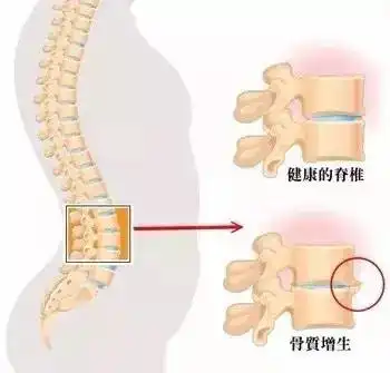 预防腰椎骨质增生,从现在开始  预防腰椎骨质增生,从现在开始