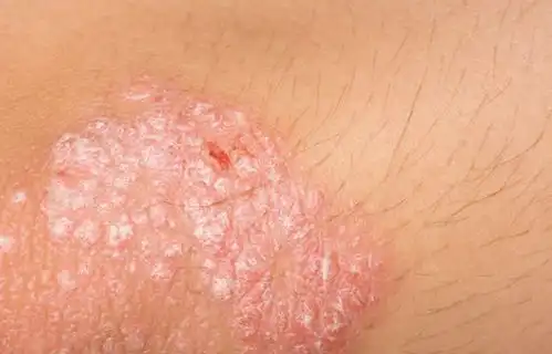  神经性皮炎的形成原因有什么