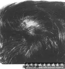  治疗头癣的方法有哪些