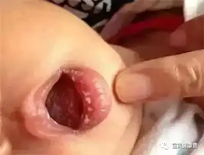  什么是马牙如何区分马牙和鹅口疮
