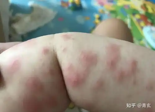  为什么手上突然长小红点