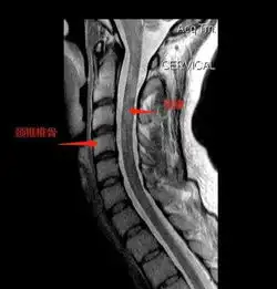 颈椎病脖子长期酸痛,推拿有危险吗  颈椎病脖子长期酸痛,推拿有危险吗
