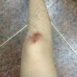  跪求女生腿受伤的图片小腿不是口味太重是我假装生病需要