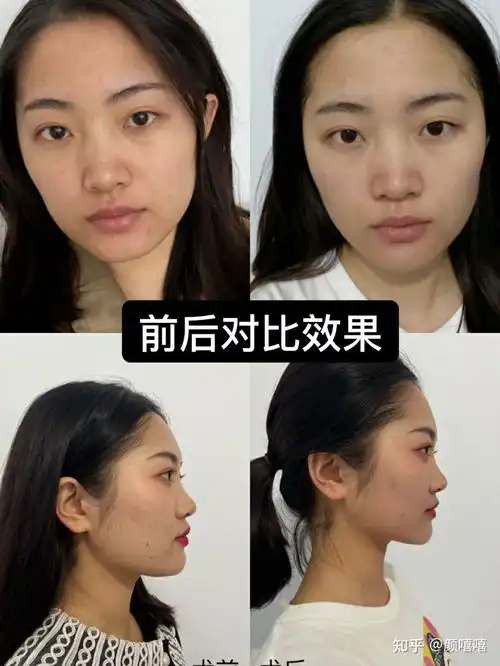  超声炮vs超声刀,抗衰神器or智商税到底哪个面部提升效果好
