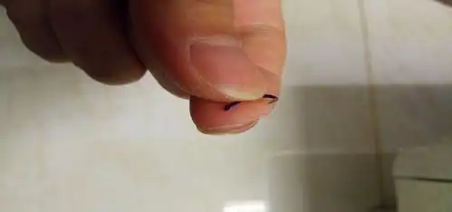  鱼钩刺肉不要慌,掌握这些处理方法,比你硬拔出来强很多