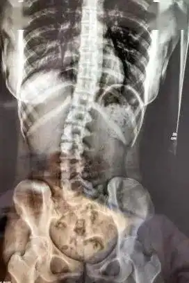  万万没想到这种睡姿会导致脊柱侧弯