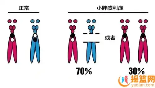 小胖威利综合征是什么有什么症状
