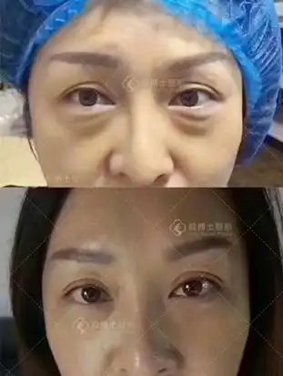  祛眼袋让你的眼睛恢复年轻神采