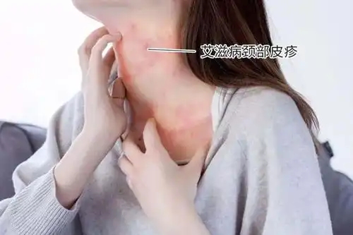  艾滋病人数新增130万医生说艾滋病有3个症状,并不难发现