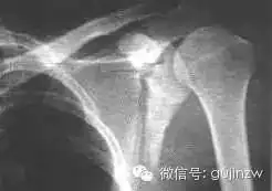  独立值班必备42张x线片带你读懂不同部位骨折