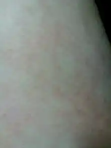  因为肥胖腿上出现了红血丝怎么办,瘦了之后会退下去吗