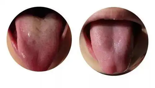  最新舌苔,掌握这几个关键点