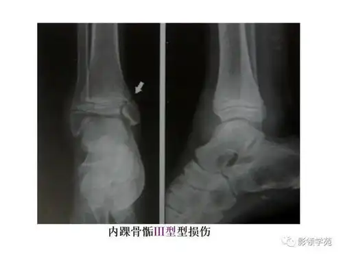  儿童骨骺损伤影像诊断