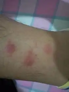  这是荨麻疹还是别的什么一开始像蚊子咬的,有点肿,很痒,后来变