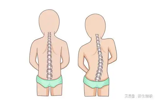  体检发现脊柱有侧弯,该如何改善
