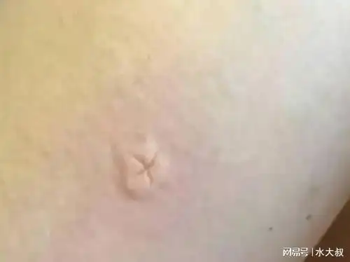  提醒蚊子最爱叮这两种人,究竟哪2种人看完涨知识了