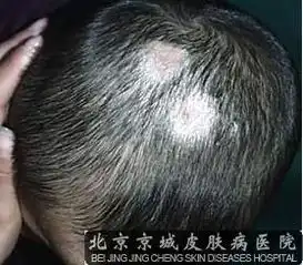  头癣的发病原因有哪些呢